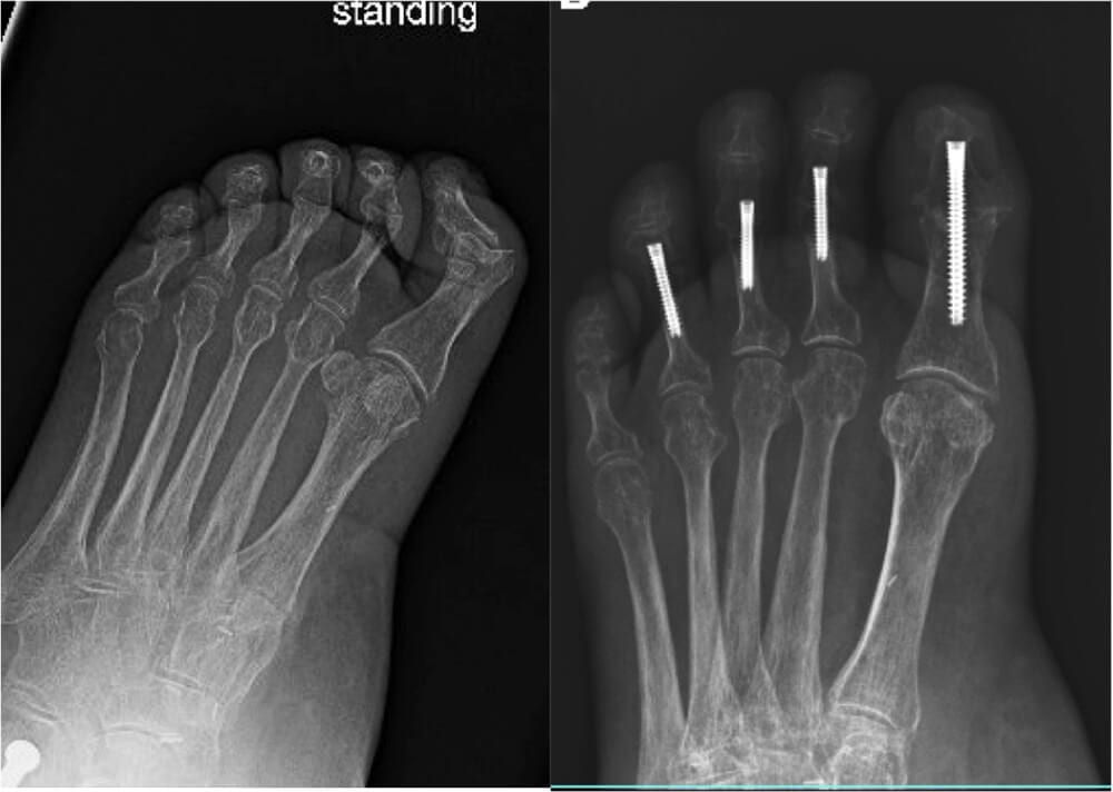 Bunions and Hammer toes - Christopher Miller